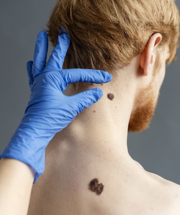 ameliyatsiz burun ucu operasyonu dikey görsel