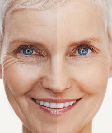 kırışıklık tedavisi dikey görsel