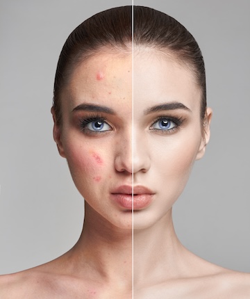 leke tedavisi dikey görsel